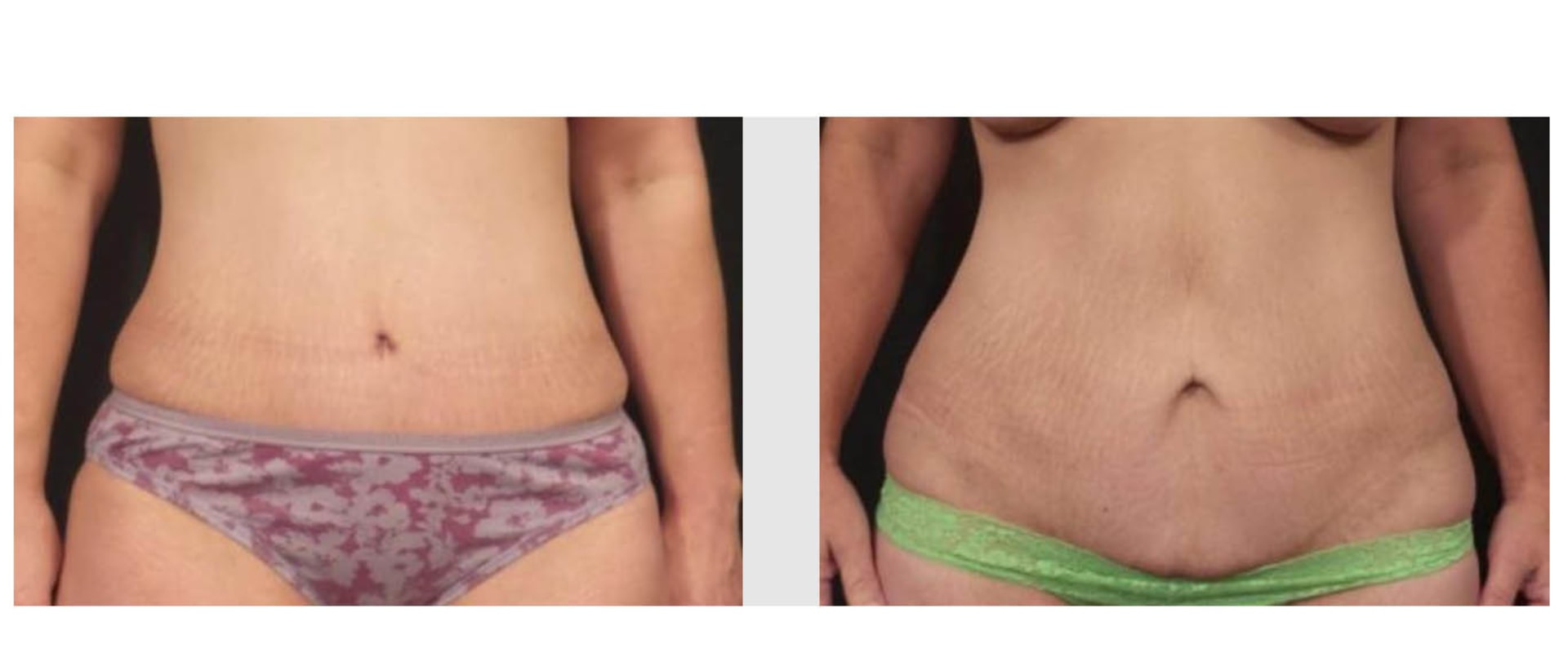 What is the failure rate of a tummy tuck?