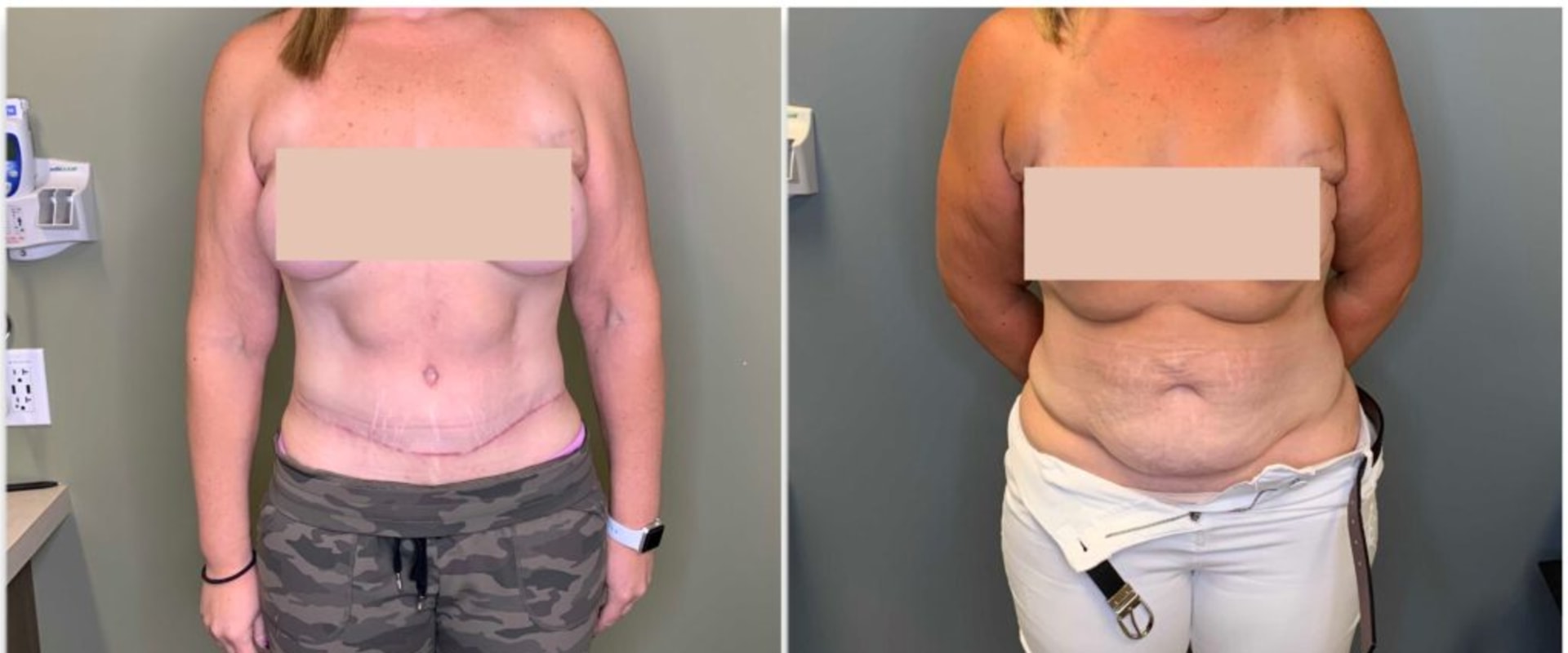 How does a tummy tuck change your body?