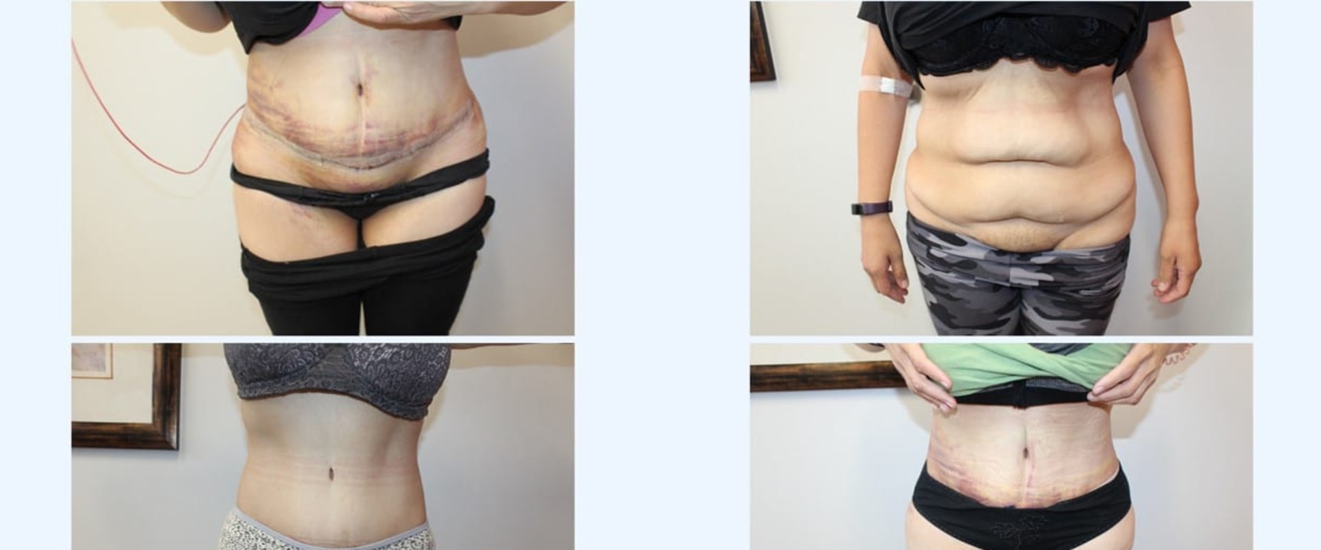 Is tummy tuck a high risk surgery?