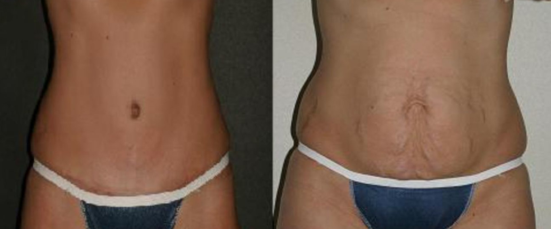 What are long term issues with a tummy tuck?