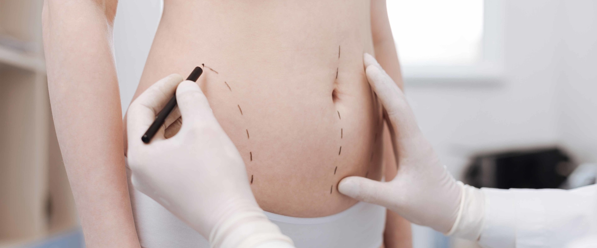 All You Need to Know About Liposuction