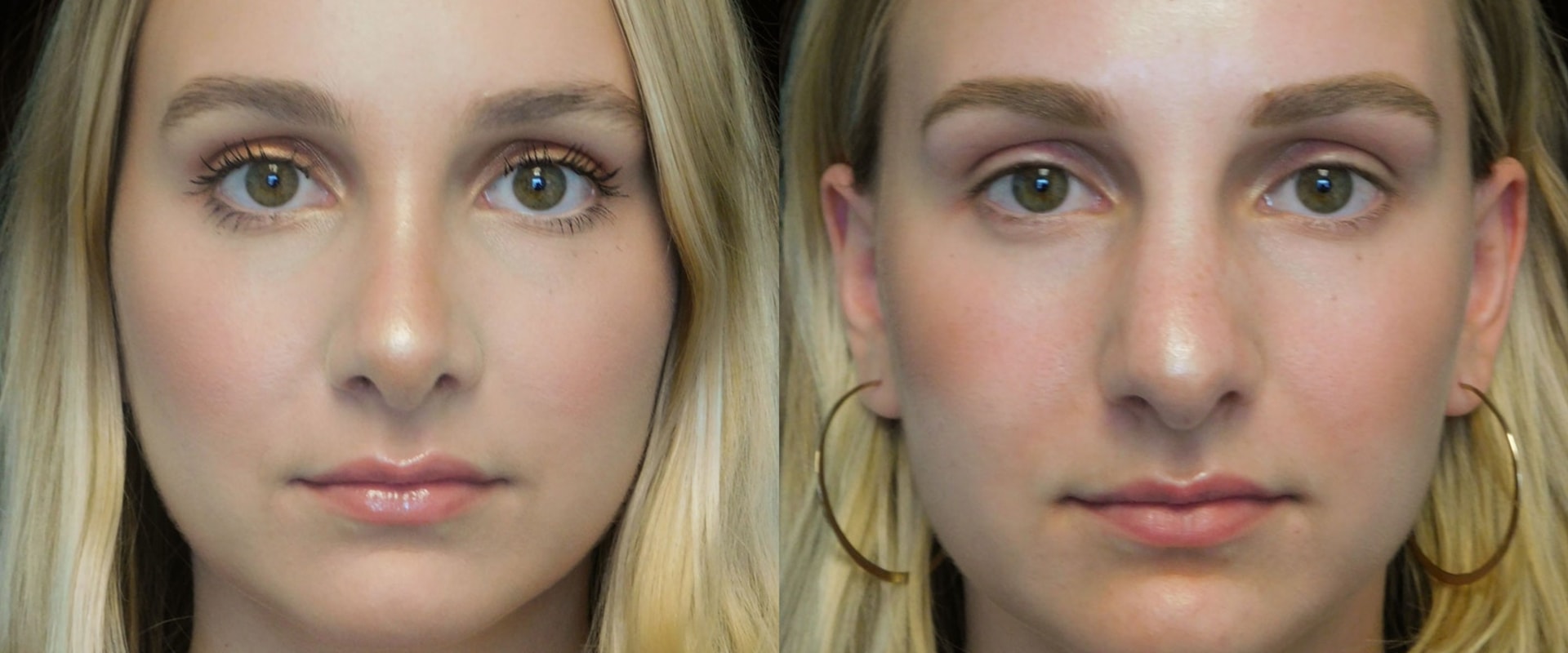 Understanding Rhinoplasty: Everything You Need to Know