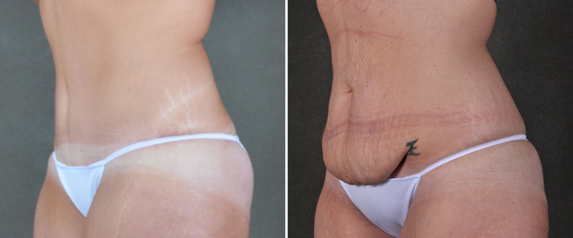 How do i know if i damaged tummy tuck?