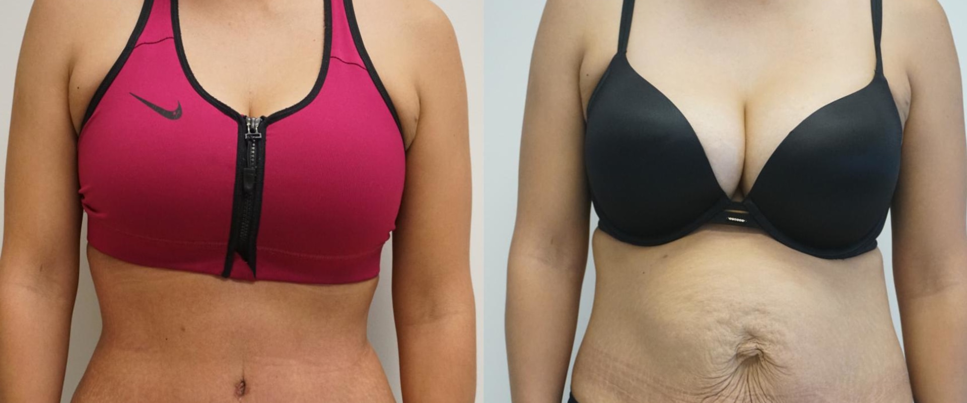 Can a tummy tuck cause problems years later?