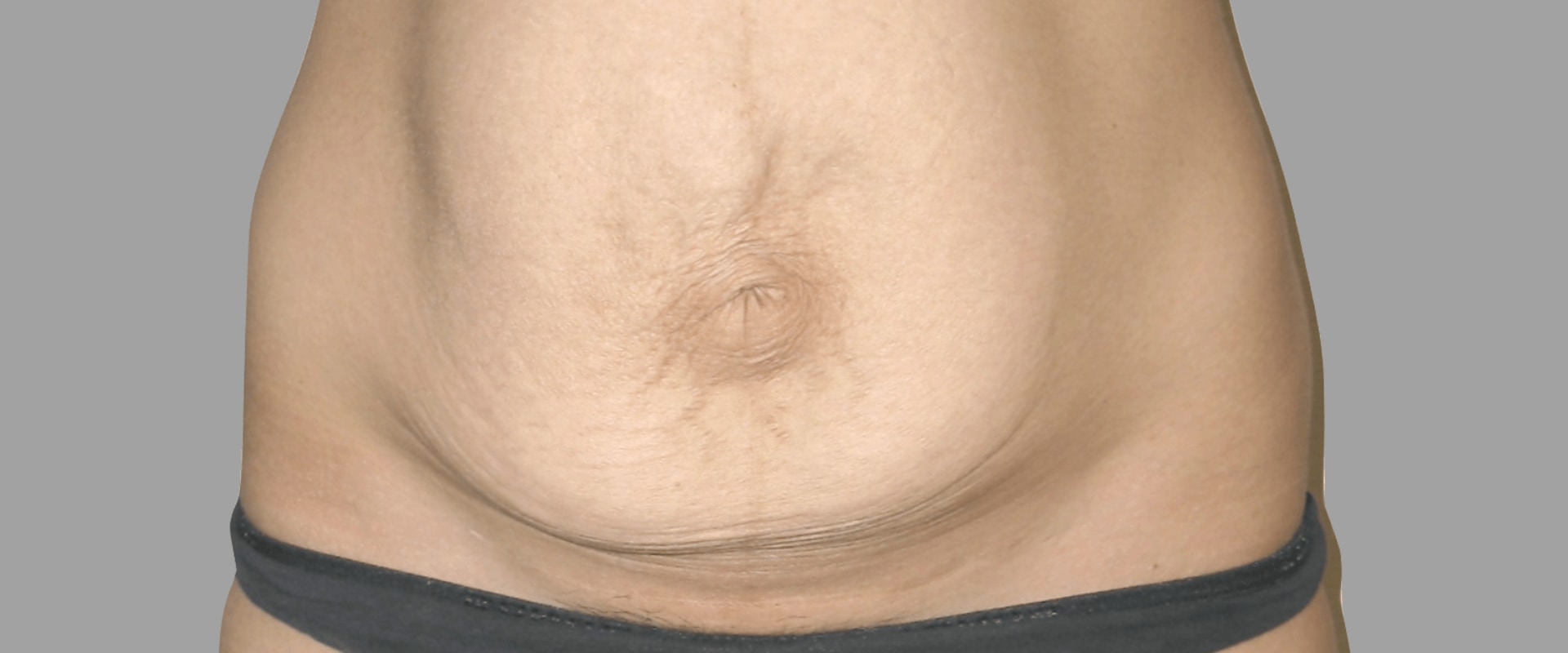 What is the disadvantage of tummy tuck?