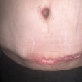 How common are tummy tuck complications?