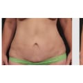 What is the failure rate of a tummy tuck?