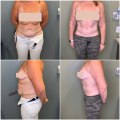 How does a tummy tuck change your body?