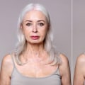 Understanding Facelift: Options, Risks, and Benefits