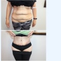 Is tummy tuck a high risk surgery?