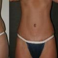 What are long term issues with a tummy tuck?