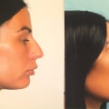 Viewing Before-and-After Photos: A Comprehensive Guide to Understanding Cosmetic Surgery