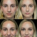 Understanding Rhinoplasty: Everything You Need to Know