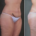 How do i know if i damaged tummy tuck?