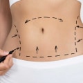 What is the satisfaction rate with tummy tuck?