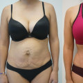 Can a tummy tuck cause problems years later?