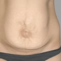 What is the disadvantage of tummy tuck?