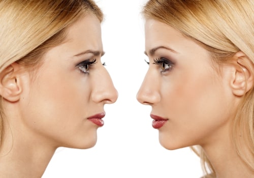 What plastic surgery has the hardest recovery?