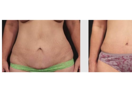 What is the failure rate of a tummy tuck?