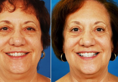 Are people happier after cosmetic surgery?