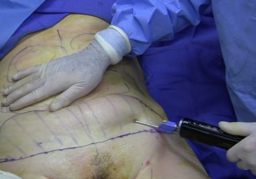 All you need to know about Laser-assisted liposuction