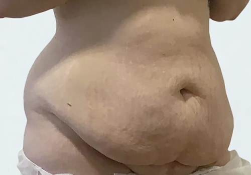 What are the worst days of tummy tuck recovery?