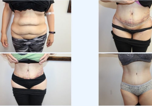 Is tummy tuck a high risk surgery?