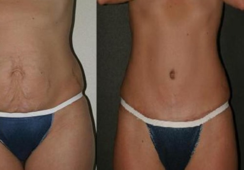 What are long term issues with a tummy tuck?