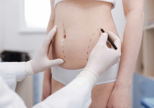 All You Need to Know About Liposuction