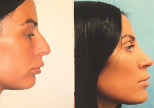 Viewing Before-and-After Photos: A Comprehensive Guide to Understanding Cosmetic Surgery