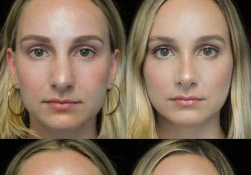 Understanding Rhinoplasty: Everything You Need to Know