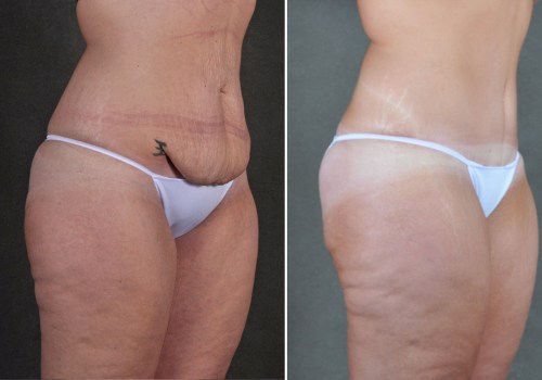 How do i know if i damaged tummy tuck?