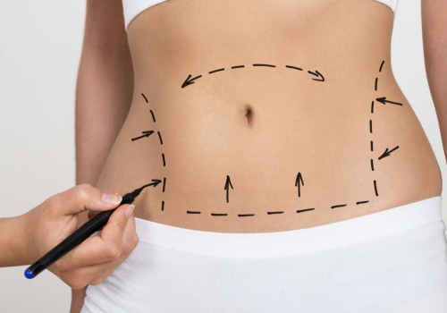 What is the satisfaction rate with tummy tuck?