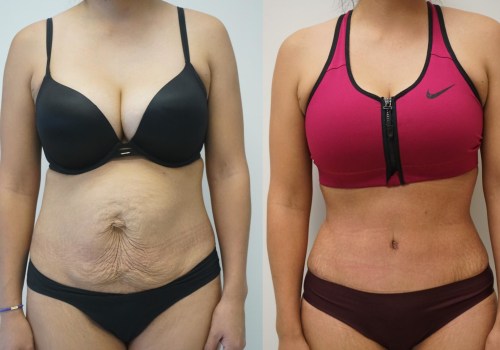 Can a tummy tuck cause problems years later?