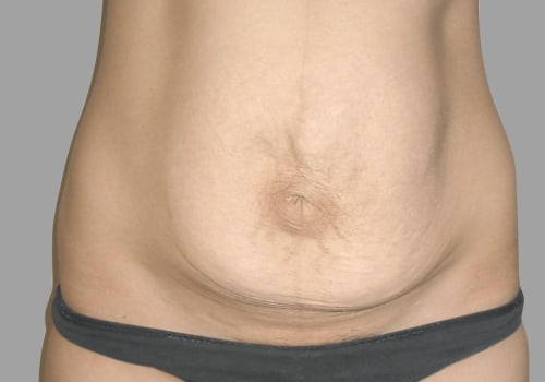 What is the disadvantage of tummy tuck?